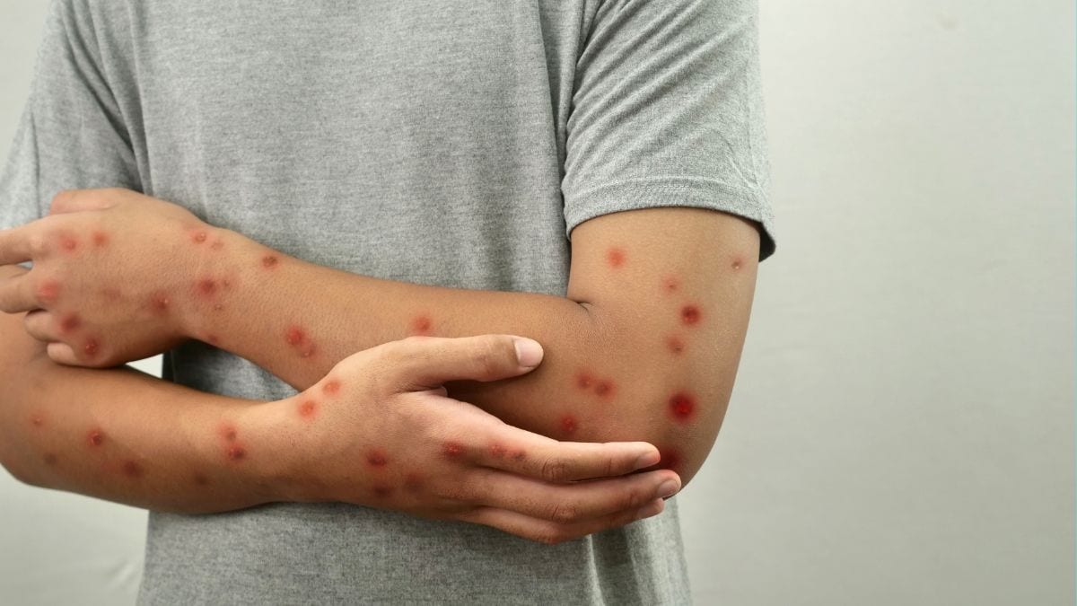 What Is Mpox? Key Facts After Mandaluyong's Confirmed Case
